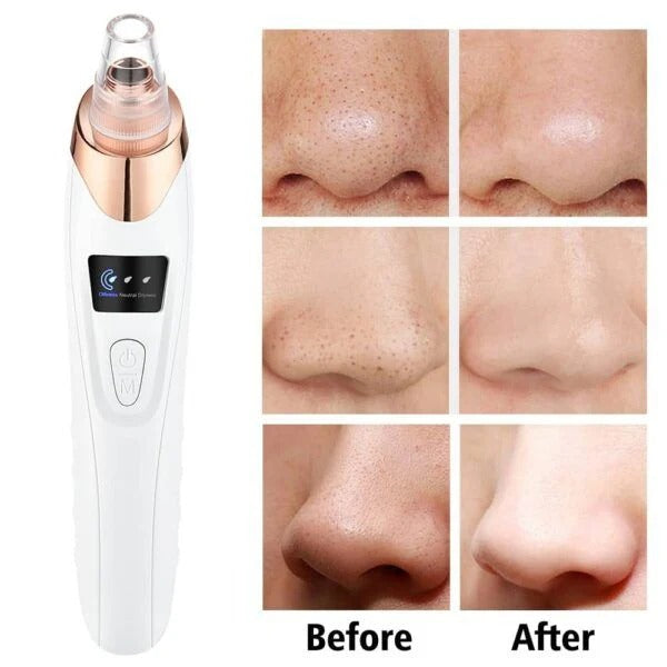 5-in-1 Rechargeable Blackhead Remover – Electric Vacuum Pore Cleaner