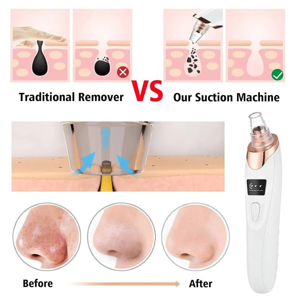 5-in-1 Rechargeable Blackhead Remover – Electric Vacuum Pore Cleaner