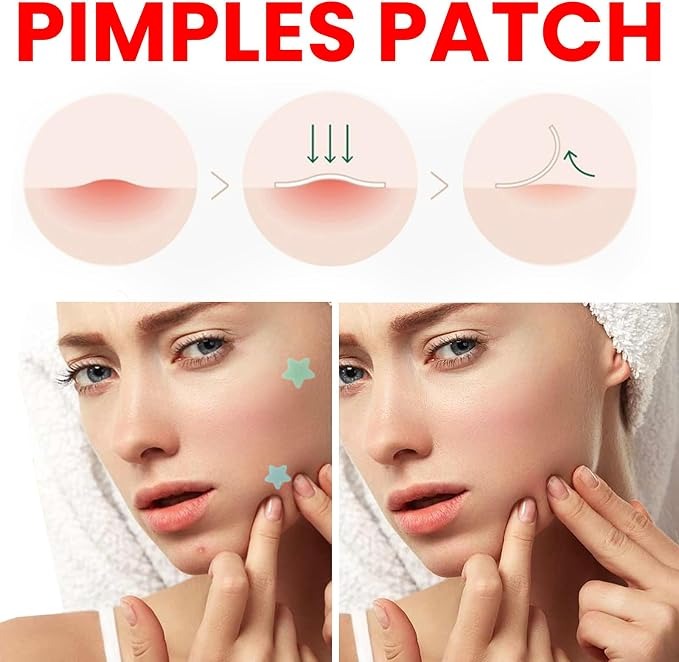 Pimple Patch Face Cover for Acne Patches with Tea Tree Oil (200 Patches)