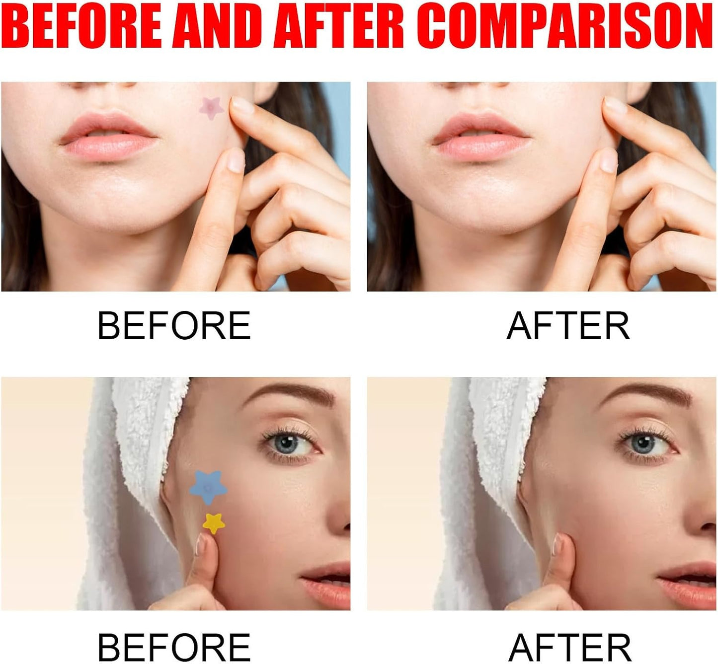 Pimple Patch Face Cover for Acne Patches with Tea Tree Oil (200 Patches)